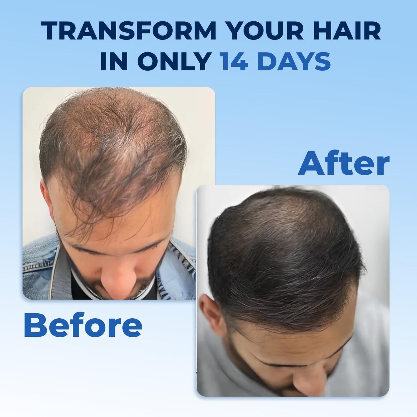 FEGPLUS Rosemary Beard & Hair Growth Serum (50ml), Rosemary Extract Serum Hair Spray